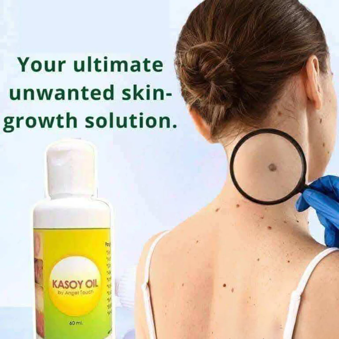 Kasoy Oil by Angel Touch – 60mL